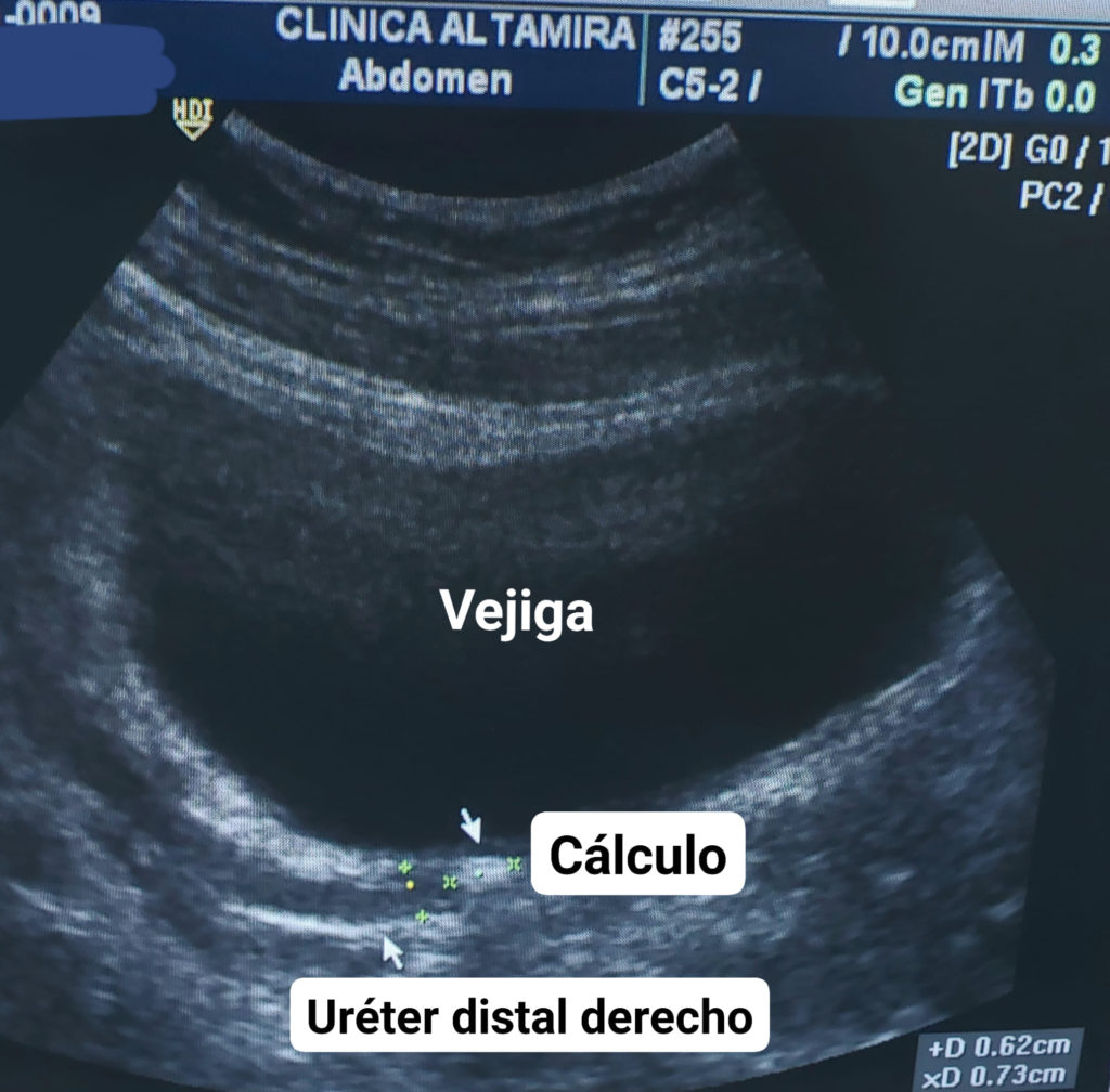 ultrasonido embarazo